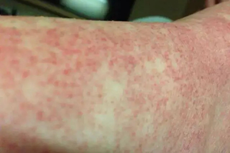 登革热红点图 登革热红点图