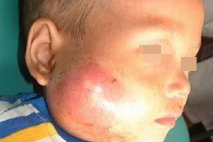 化脓性腮腺炎肿大腮图