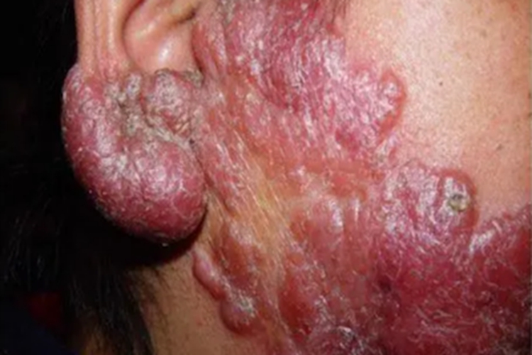 疣状皮肤结核面部症状图