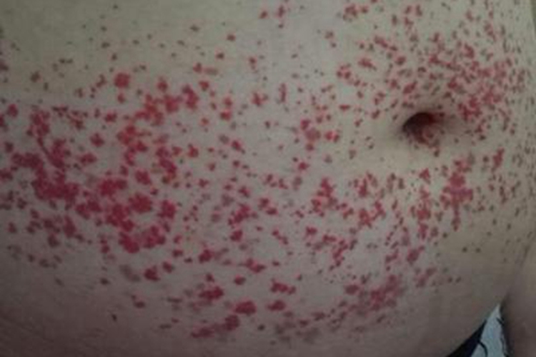 冷球蛋白血症性紫癜腹部紫斑图