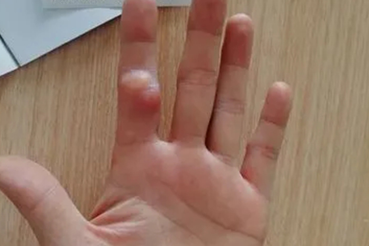 手指皮样囊肿图