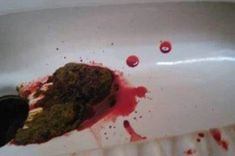 痔疮出血大便图