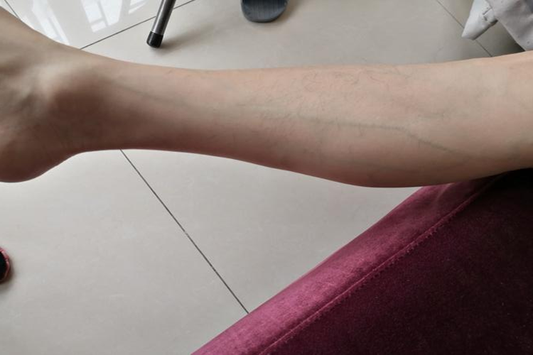 小腿静脉明显图