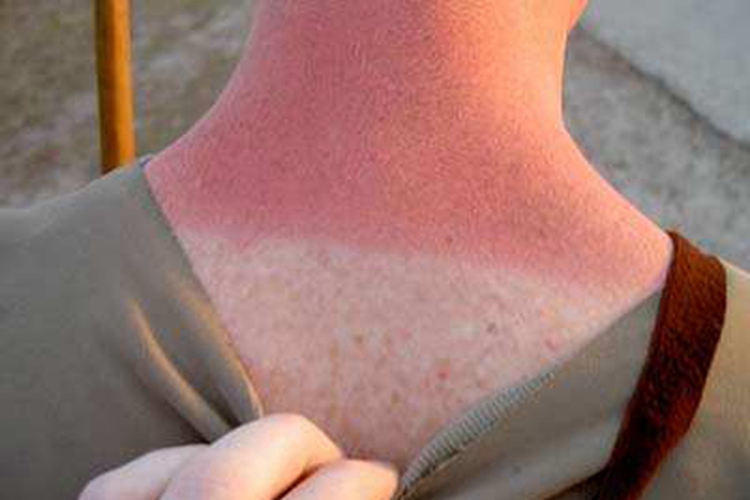 光接触性皮炎后颈红斑图