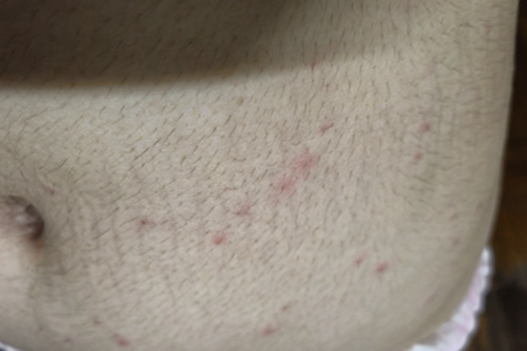 昆虫性皮炎腹部丘疹图