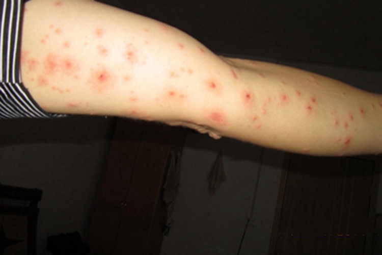 丘疹型轻型多形红斑胳膊红斑图 丘疹型轻型多形红斑胳膊红斑图
