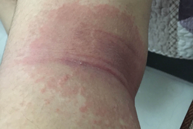 红痱肘窝有一大片红斑图