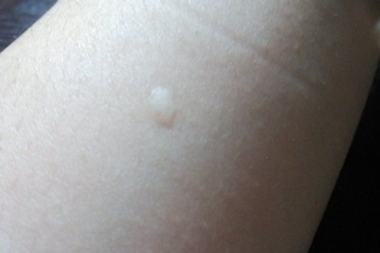 斑状萎缩胳膊小疙瘩图 斑状萎缩胳膊小疙瘩图