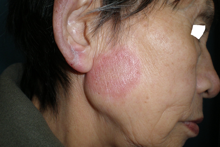 亚急性皮肤型红斑狼疮面部症状图