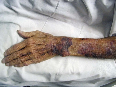 手臂血斑图片图片