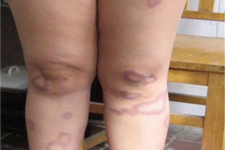 麻风病腿症状图 麻风病腿症状图