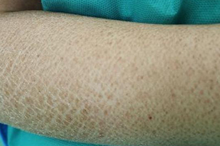 蛋白质营养不良皮肤粗糙图 蛋白质营养不良皮肤粗糙图