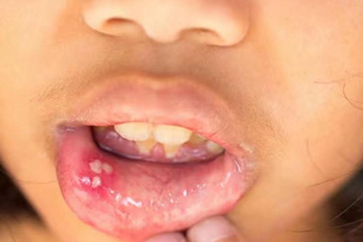 口蹄病症状图 口蹄病症状图