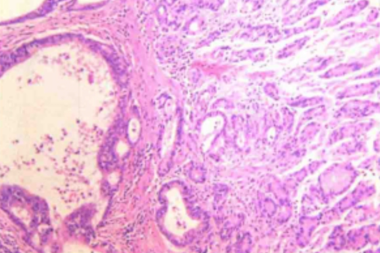 中分化管状腺癌组织病理图