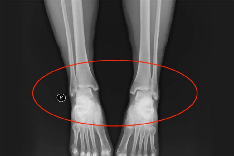 踝关节正位X线片