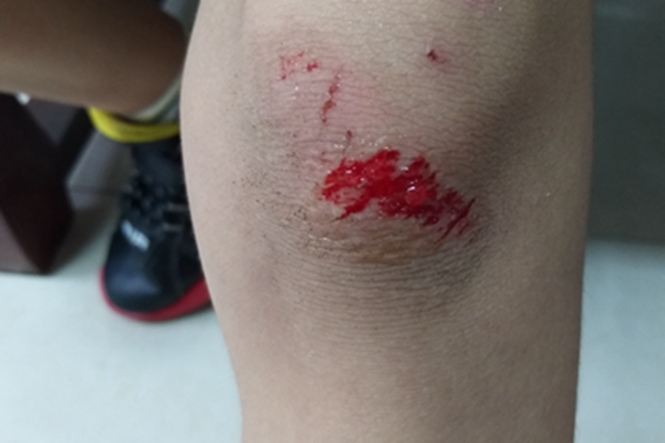 跌伤膝盖破口流血图 跌伤膝盖破口流血图