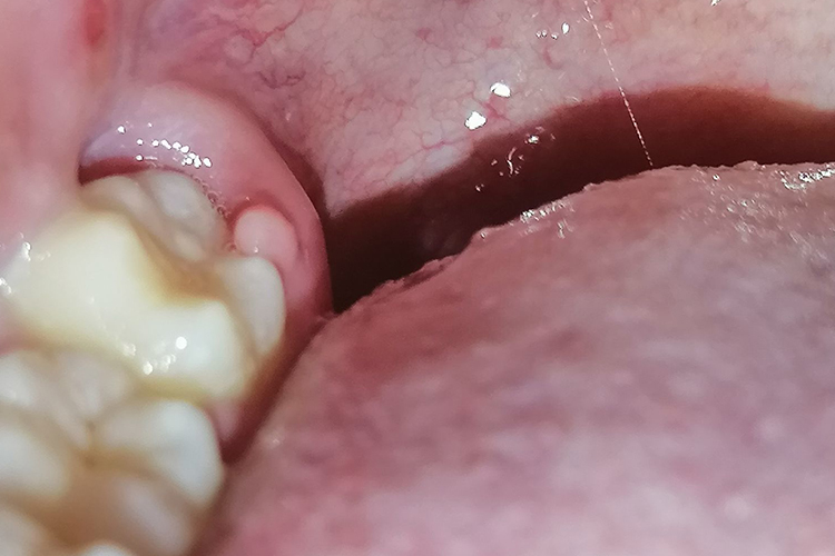 后槽牙后面的肉发白溃烂图