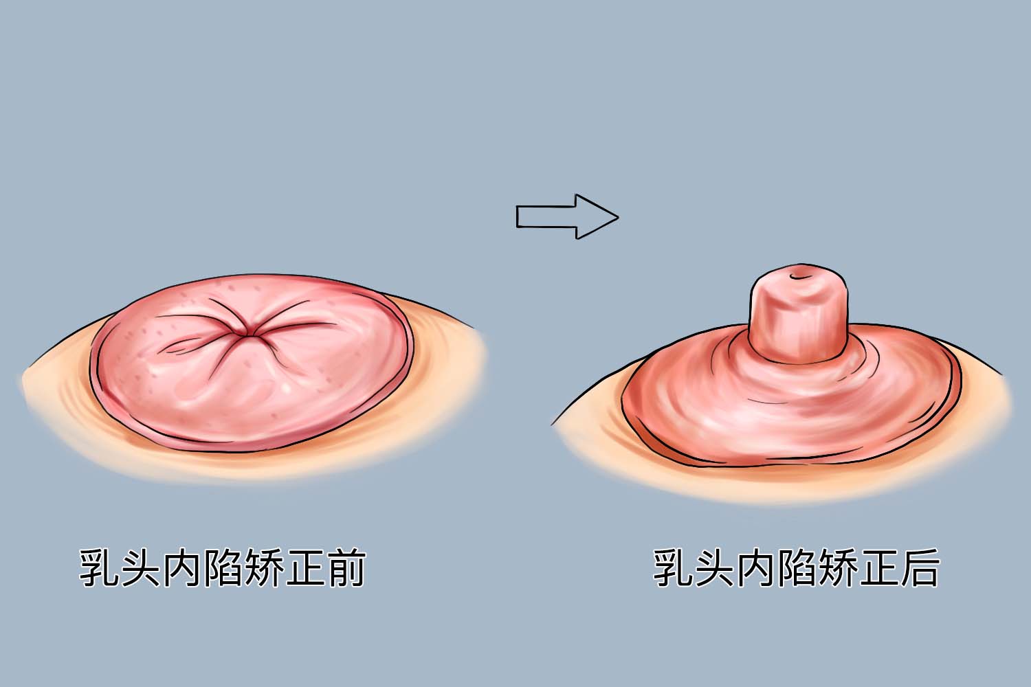 乳头正常突出凸起图片