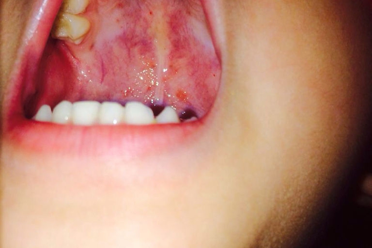 巨球蛋白血症性紫癜口腔红斑图