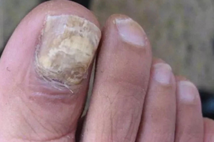 全甲损毁型甲真菌病脚趾甲变厚图