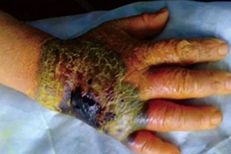 蜂窝织炎手背色素沉着图 蜂窝织炎手背色素沉着图