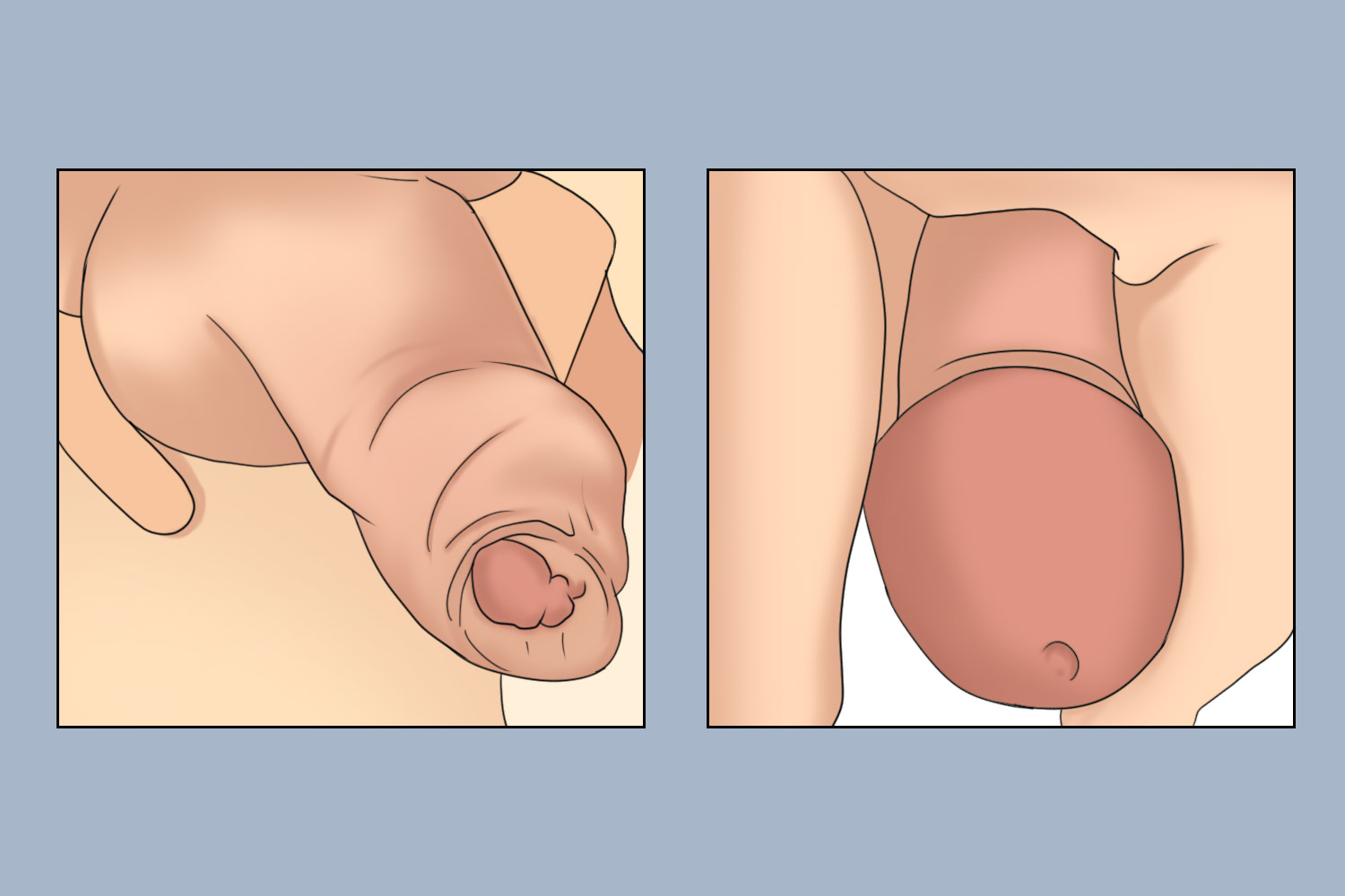 包皮过长阴茎体皮肤堆积和正常包皮图
