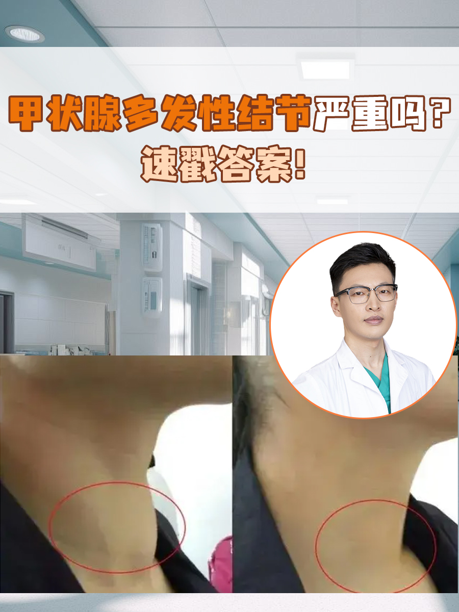 甲状腺多发性结节严重吗？速戳答案！