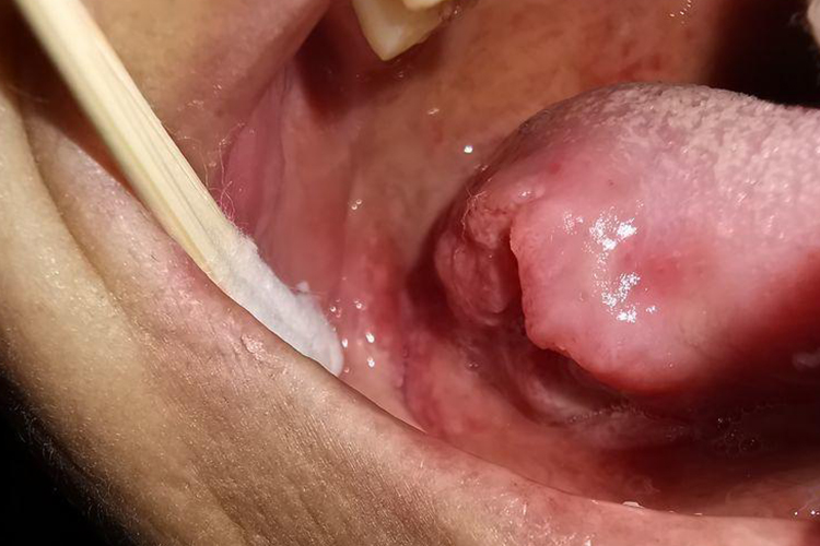 舌癌病灶处缺损图