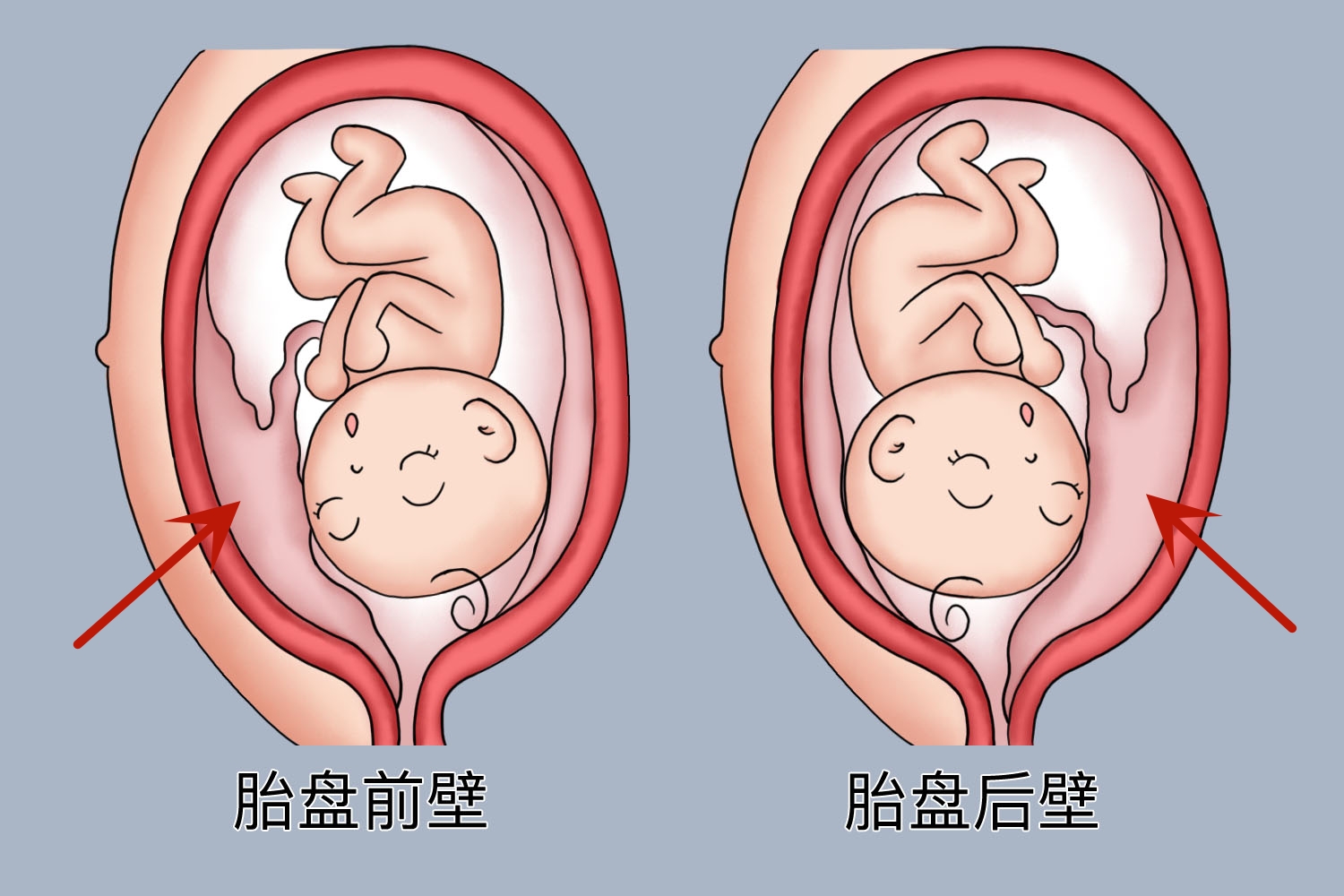 胎盘前壁图片图片