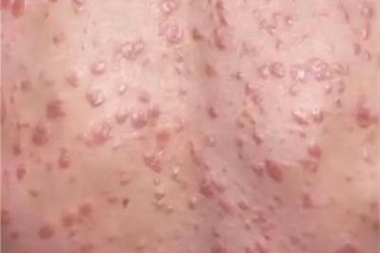 结节性梅毒疹背部丘疹图 结节性梅毒疹背部丘疹图