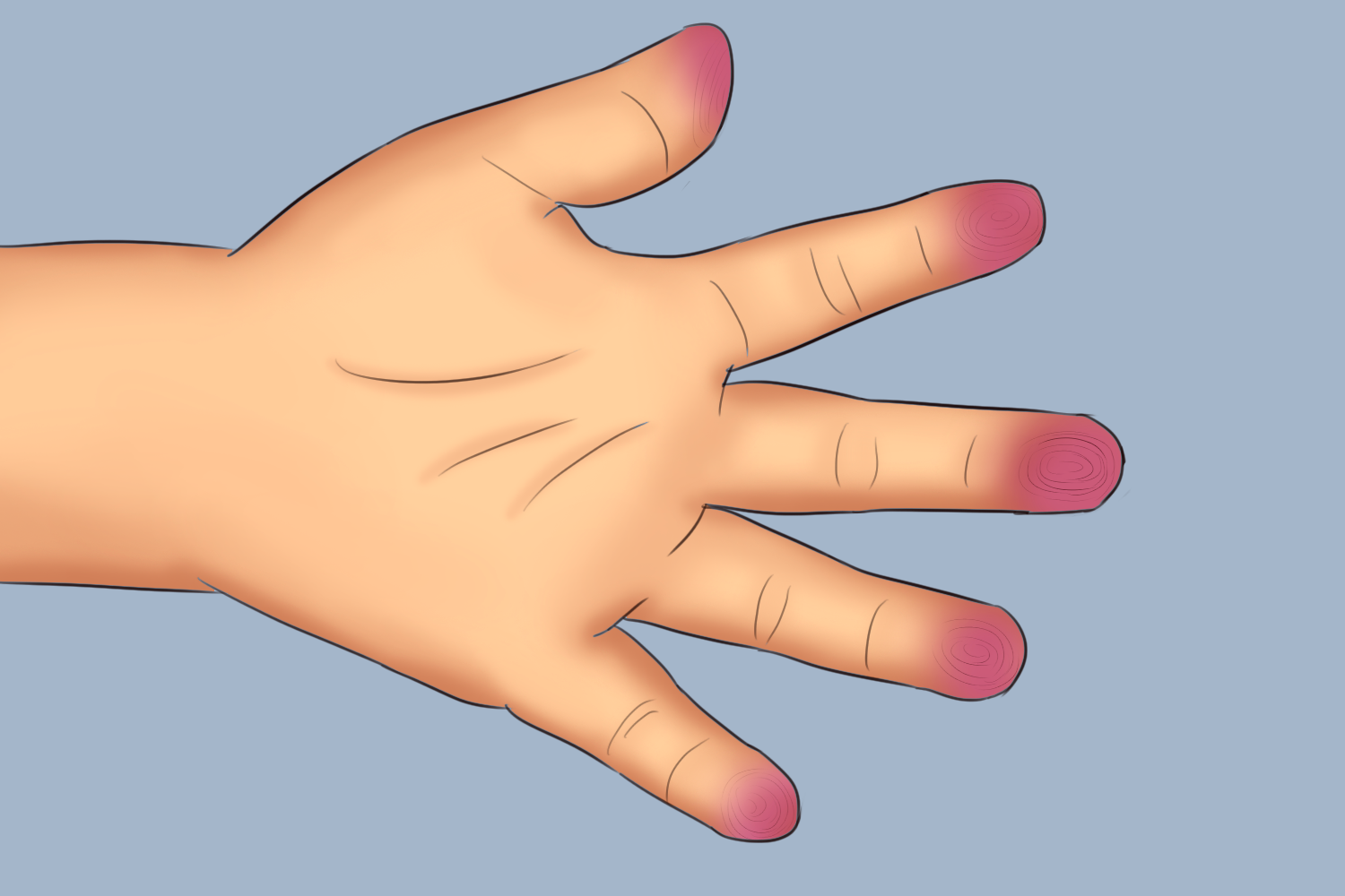 小儿指纹偏红另外,病理指纹颜色变化还常见青,淡白,紫黑等,其主病各有