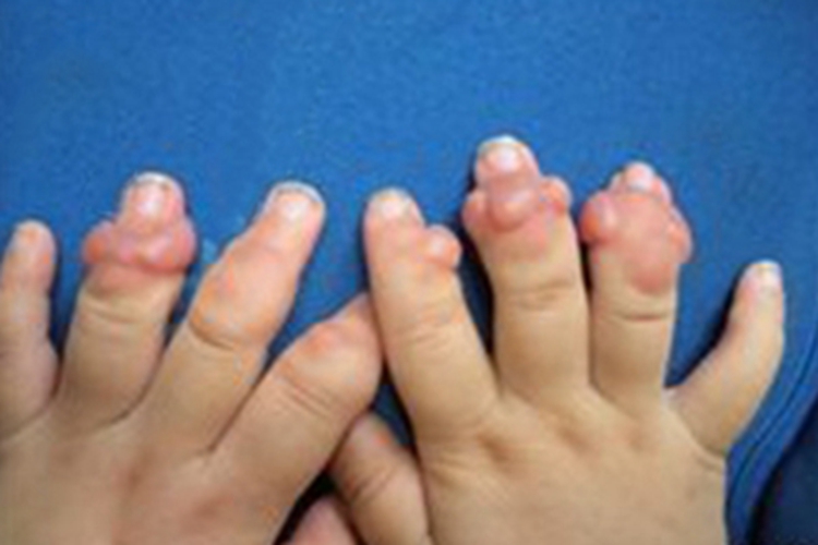 掌跖纤维瘤病手指疙瘩图 掌跖纤维瘤病手指疙瘩图