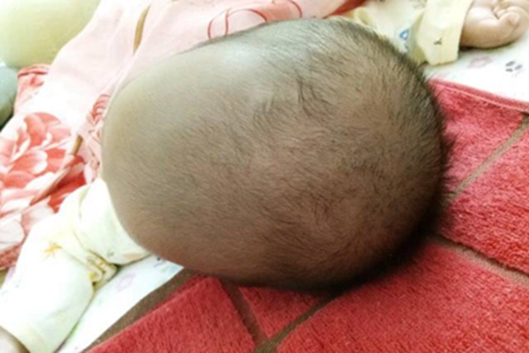 狭颅症头部前窄后宽图