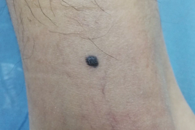 蓝色橡皮疱样痣小腿结节图