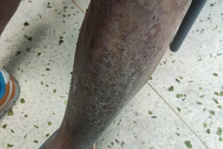 炎症后色素沉着小腿症状图 炎症后色素沉着小腿症状图