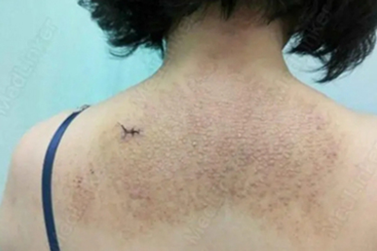 苔藓样淀粉样变病症状图