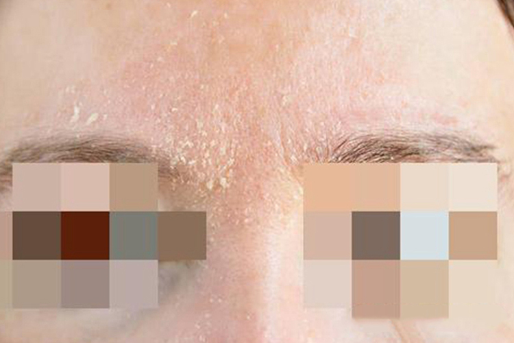 特应性皮炎白色皮屑图