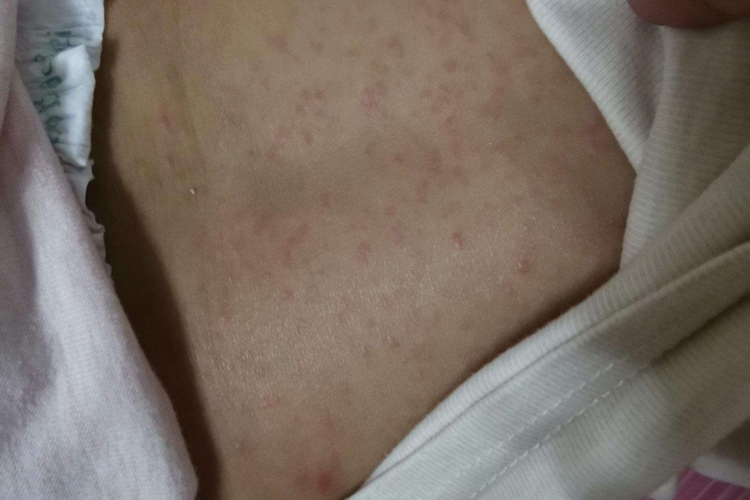 幼儿急疹图 幼儿急疹图