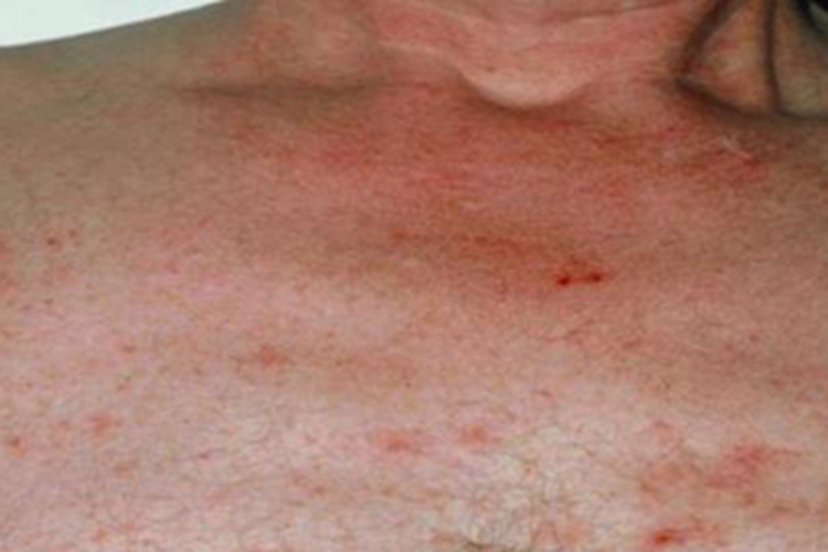 肝硬化胸前红点图