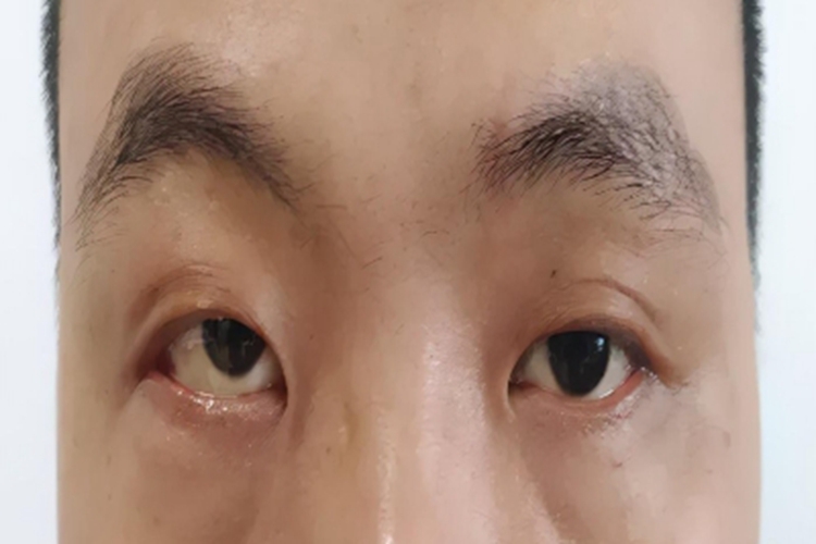 眼眶淋巴瘤眼球凸起图