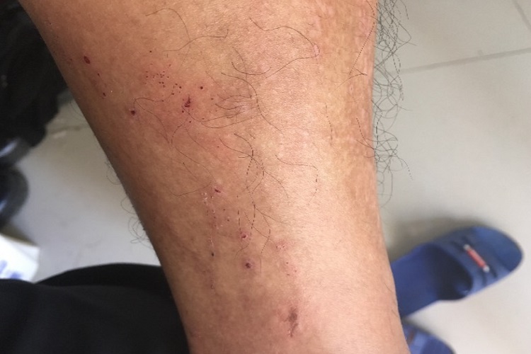 瘙痒症小腿血痂图