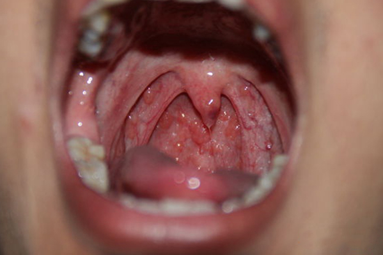 急性咽炎小红点图