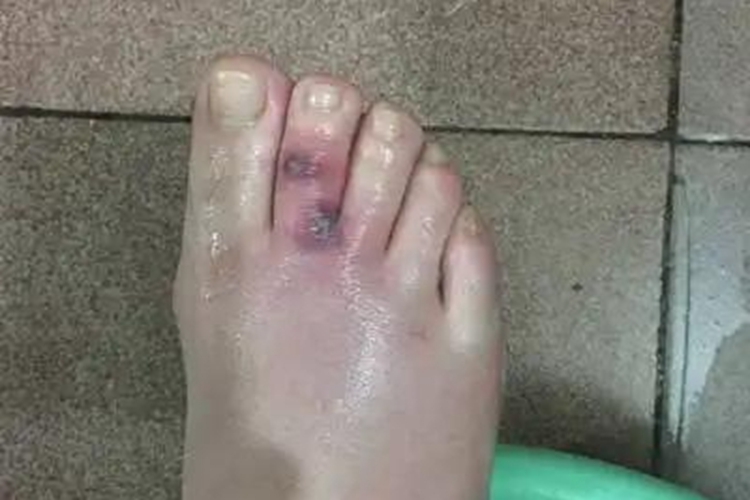 蜱咬伤脚上有红肿溃疡图