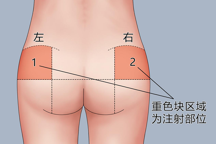 臀部打针位置图片