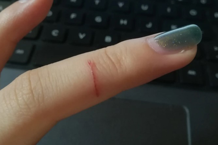 手指割伤真实图 手指割伤真实图