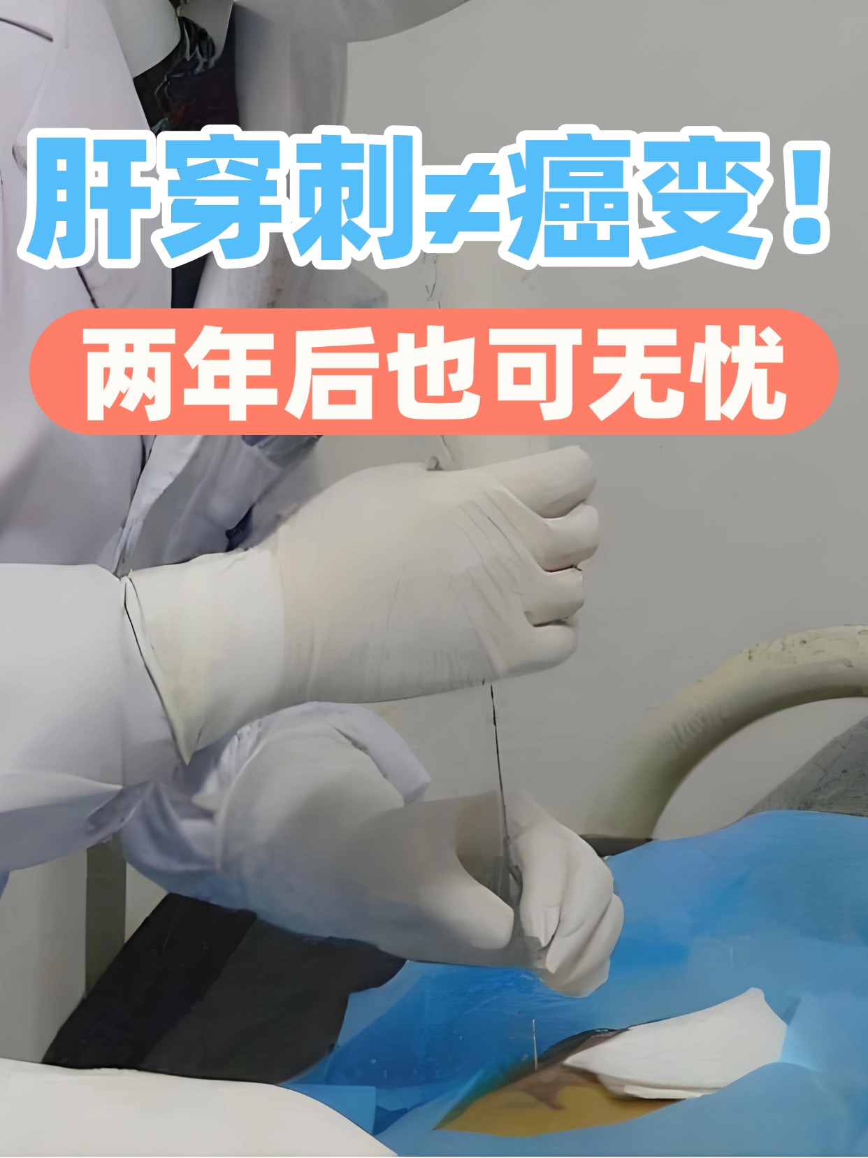 肝穿刺≠癌变！两年后也可无忧