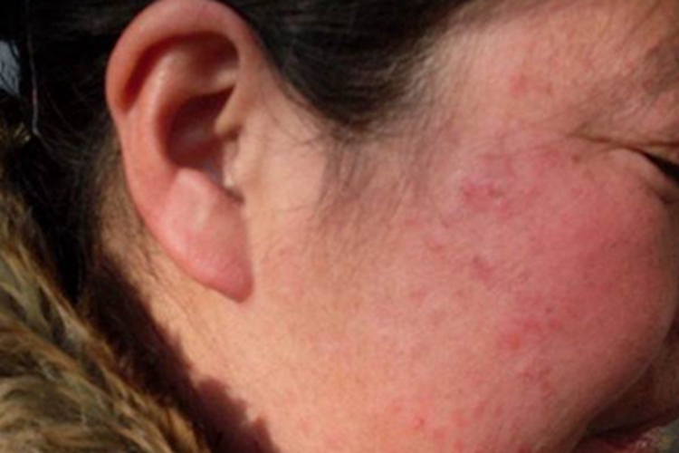 色素性化妆品皮炎面部潮红图