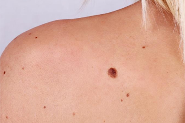 发育不良痣黑痣图 发育不良痣黑痣图