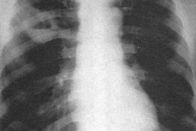 肺结核胸片图