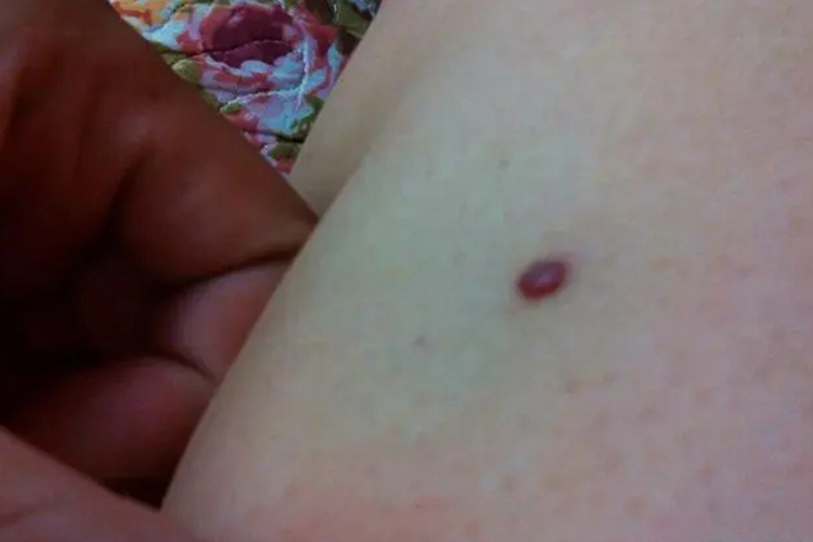 身上皮肤血管痣图